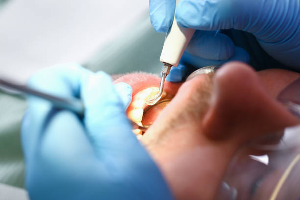 Best Emergency Dentist for Lost Fillings or Crowns in Citronelle, AL