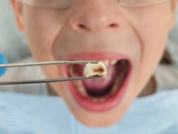Best Broken or Cracked Tooth Emergency Dentist in Citronelle, AL