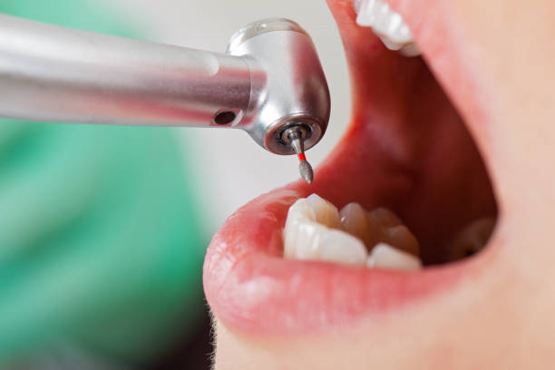 Best Emergency Root Canal Treatment in Citronelle, AL